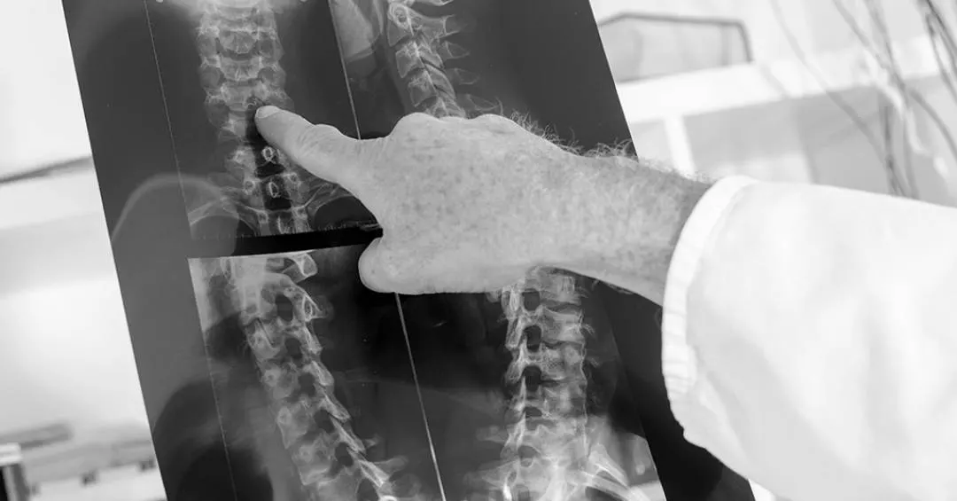 Como funciona o medicamento brasileiro que pode ajudar a recuperar movimentos após lesões na medula